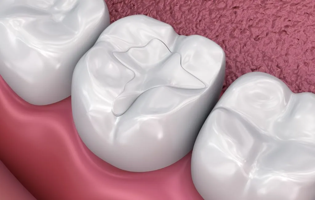 dental fillings near me