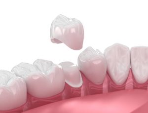 same day crowns benefits