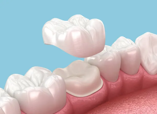 same day crowns in downtown toronto on