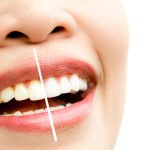 In-Office vs. At-Home Teeth Whitening: Which Works Better?