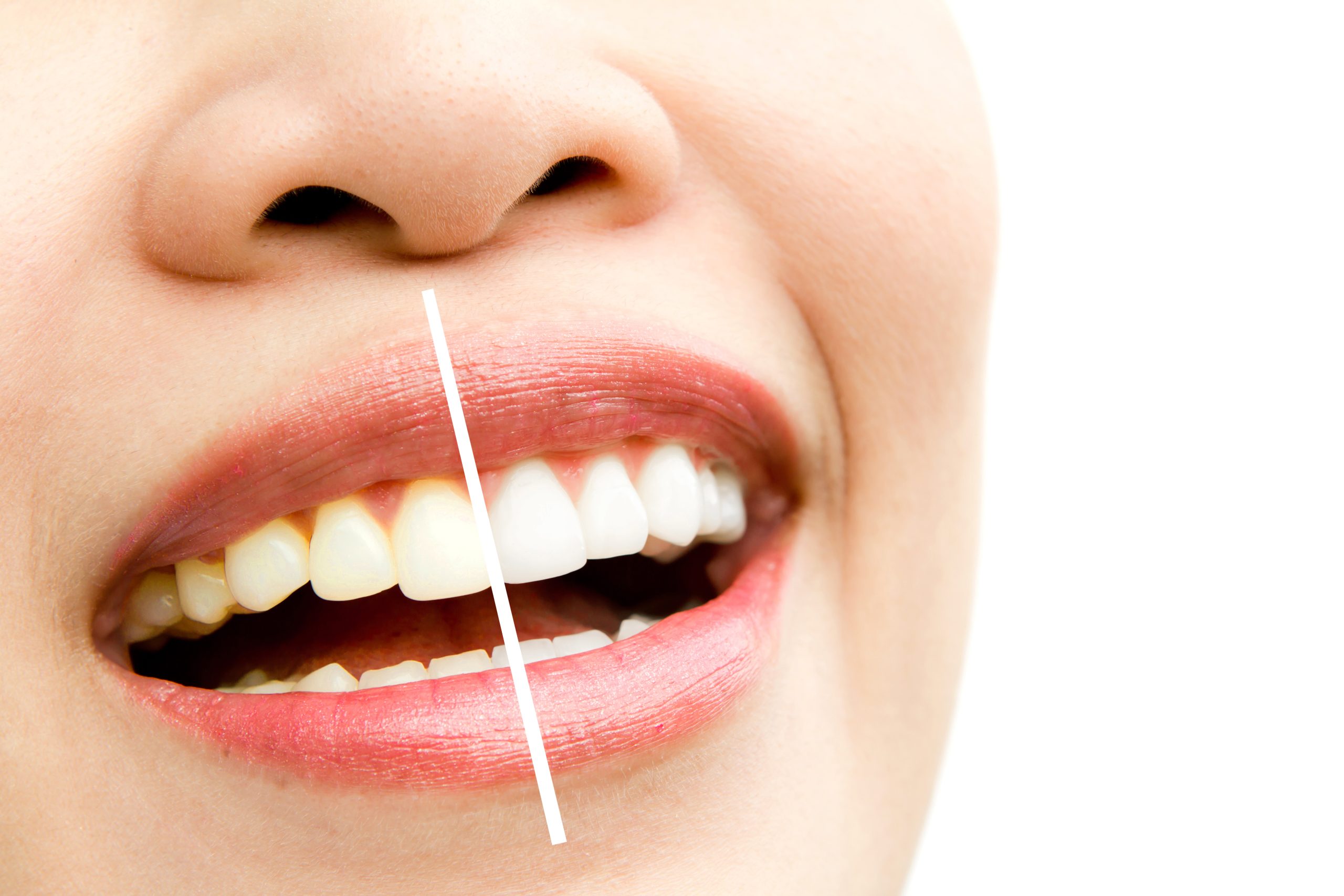 In-Office vs. At-Home Teeth Whitening: Which Works Better?