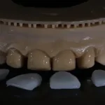 What Are Veneers and How Do They Improve Your Teeth?