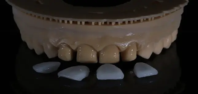 What Are Veneers and How Do They Improve Your Teeth?